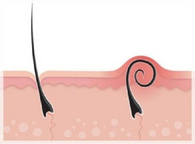 vaginales