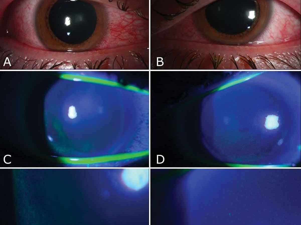 daños oculares por lámparas germicidas - NA
