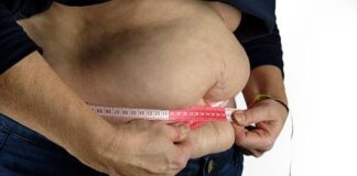 sobrepeso y obesidad - NA