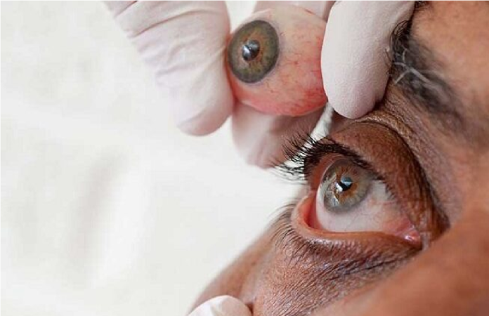 primera prótesis ocular en 3D