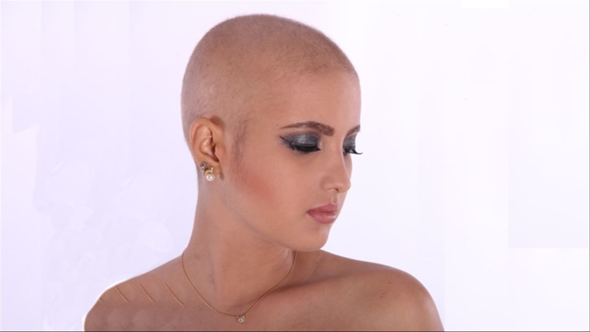 alopecia - alopecia