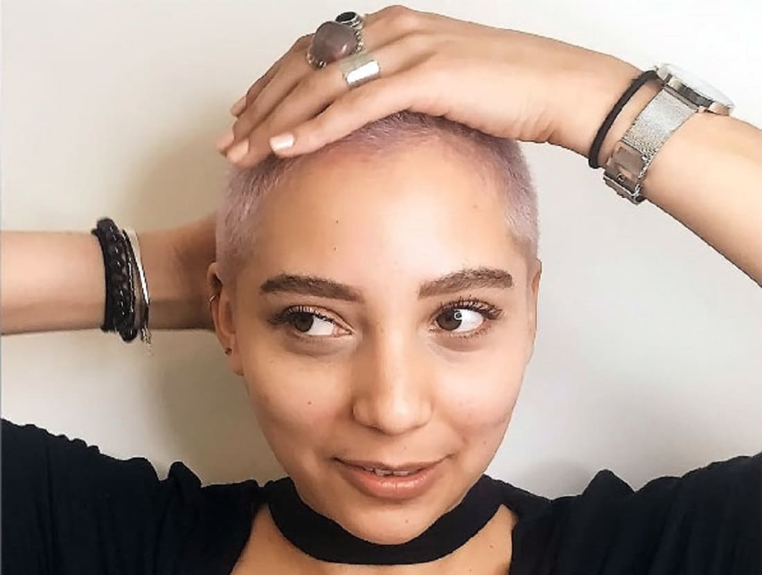 alopecia - alopecia