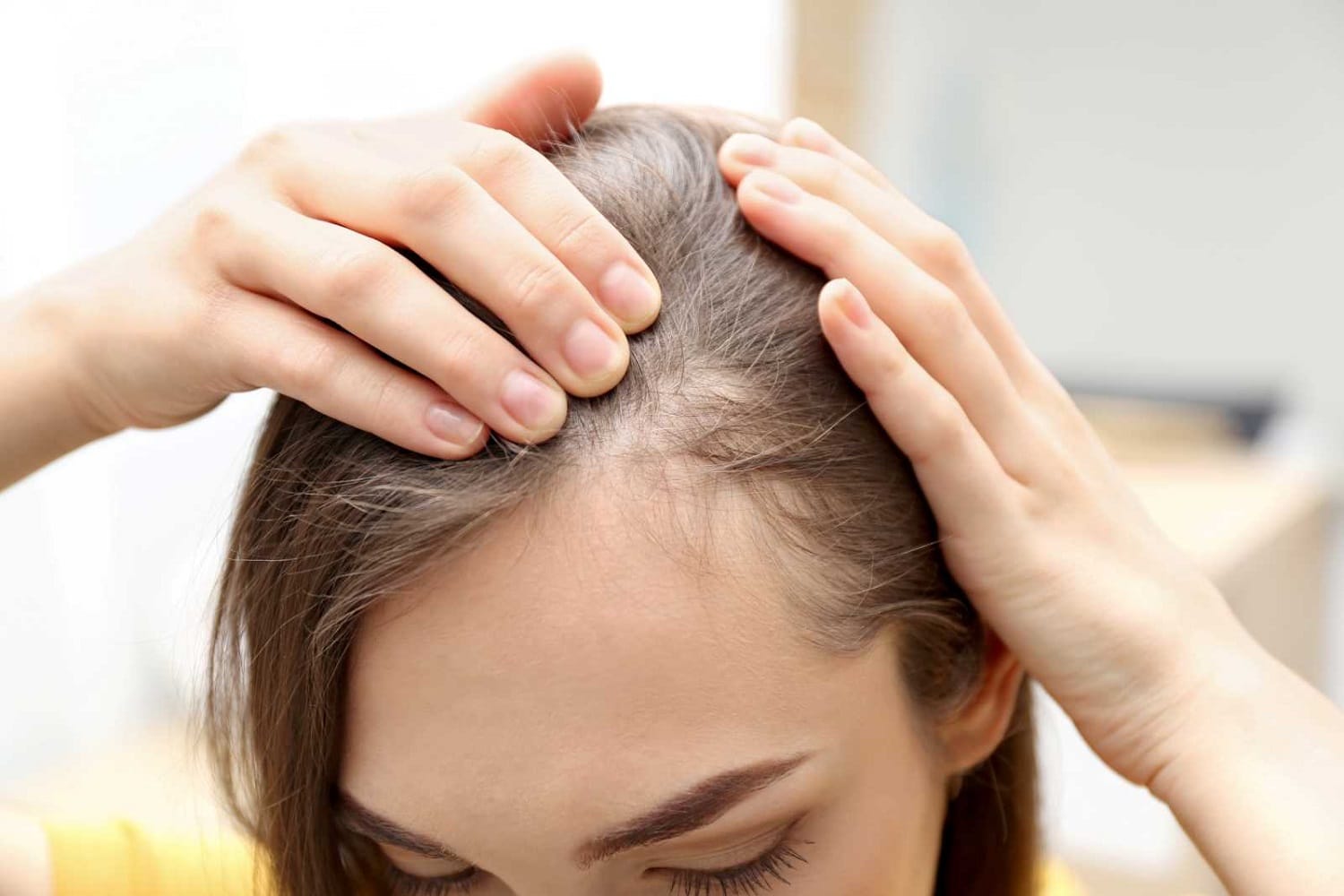 tratar la alopecia en EEUU