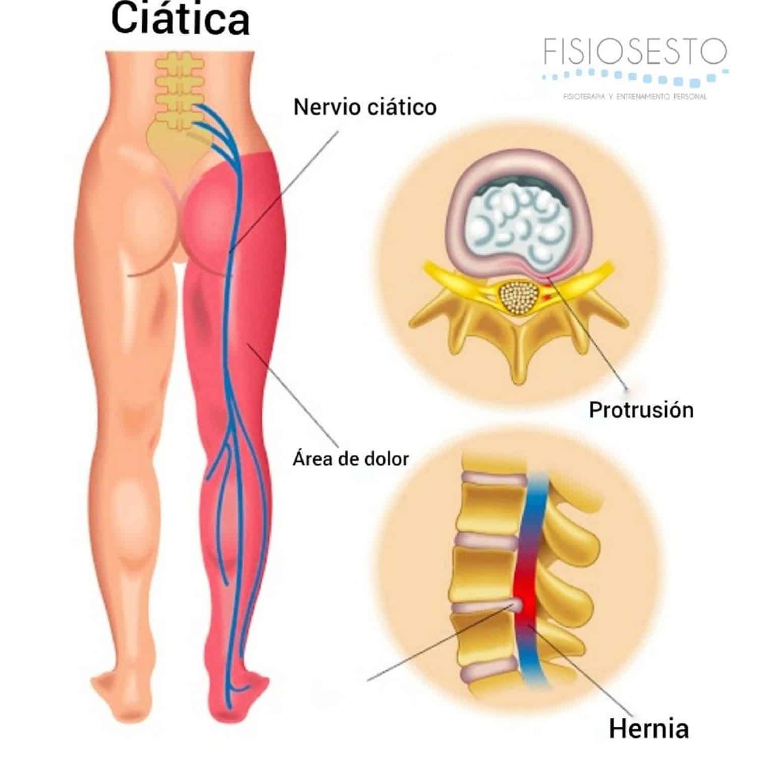 nervio ciático