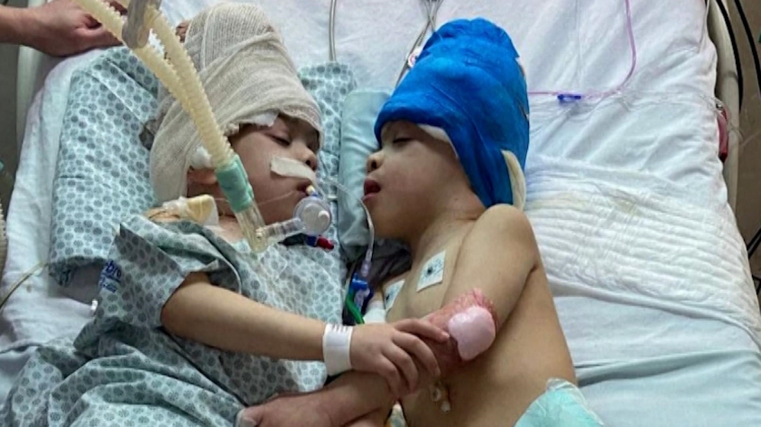 Dos gemelos siameses fueron separados